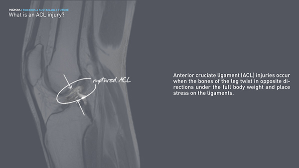 Smart ring，medical care，recovery，NOKIA，