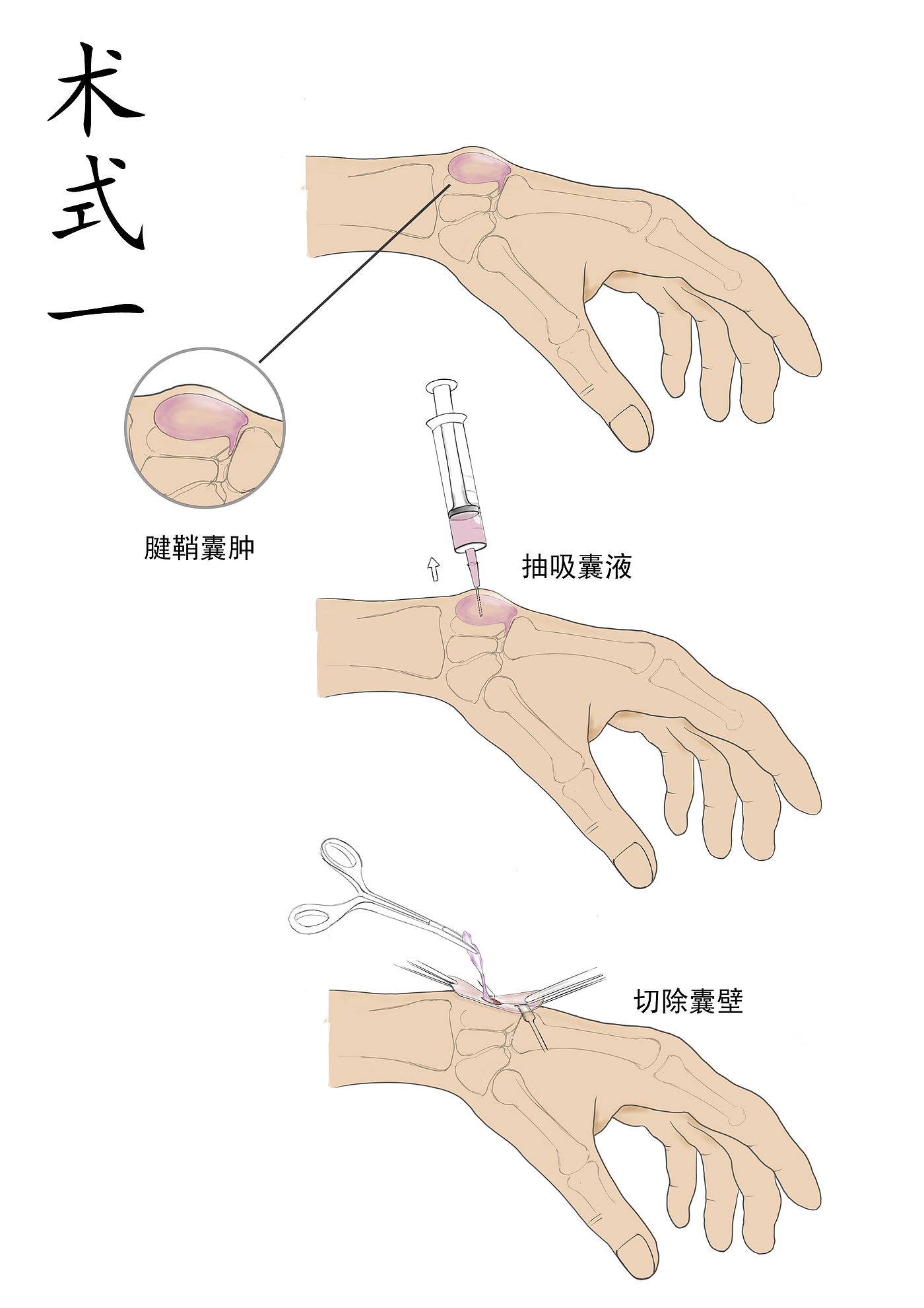 聊聊“腱鞘囊肿”那点事，微创 OR 手术治疗？_腱鞘囊肿_介绍_症状表现_如何预防_治疗方式_日常注意事项 - 好大夫在线