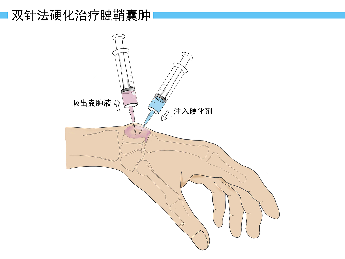 腱鞘炎に注意！ – ree