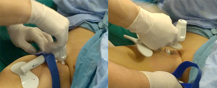 Medical equipment，product design，industrial design，Medical product design，