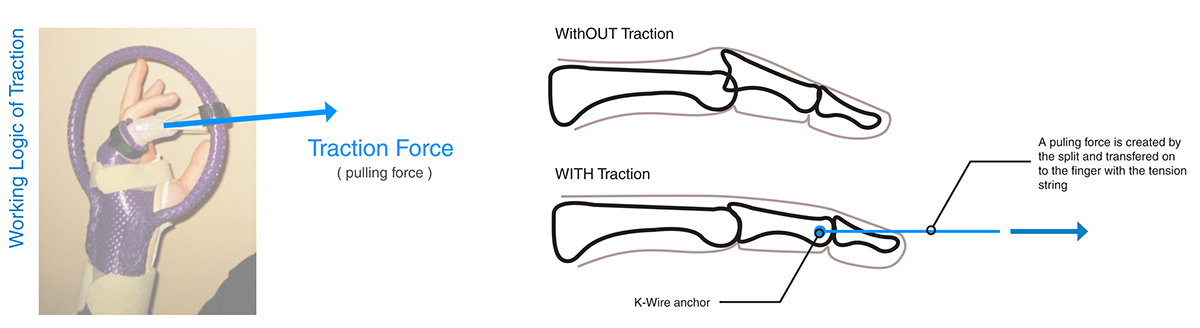 bend，finger，Medical Science，revolution，treatment，