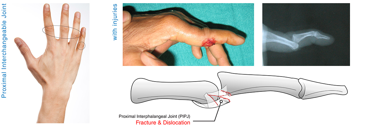 bend，finger，Medical Science，revolution，treatment，