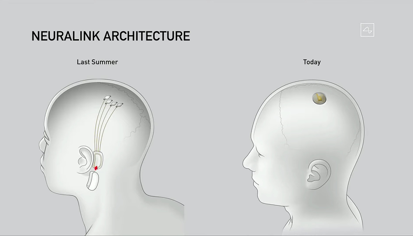 chip，Neuralink，operation，robot，Brain implantation，neuroscience，