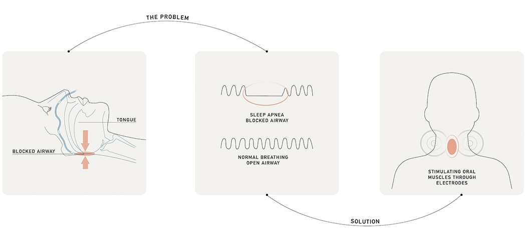 Apnea，sleep，Electric pulse，