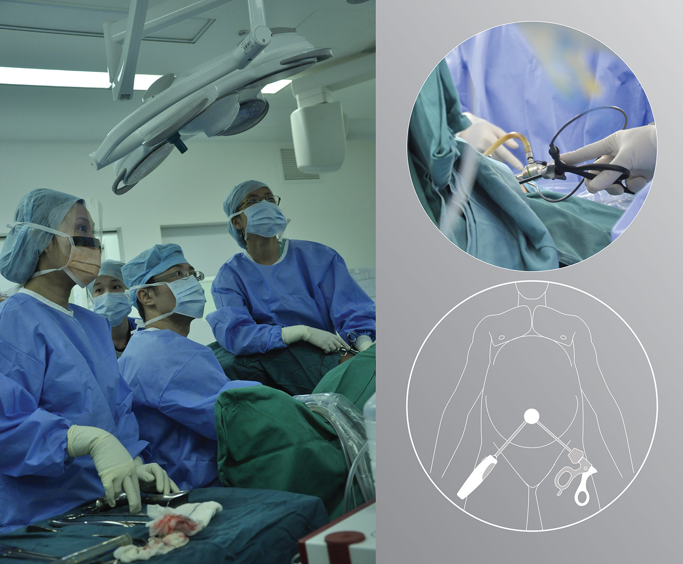 Single Port Laparoscopic Device Suturing