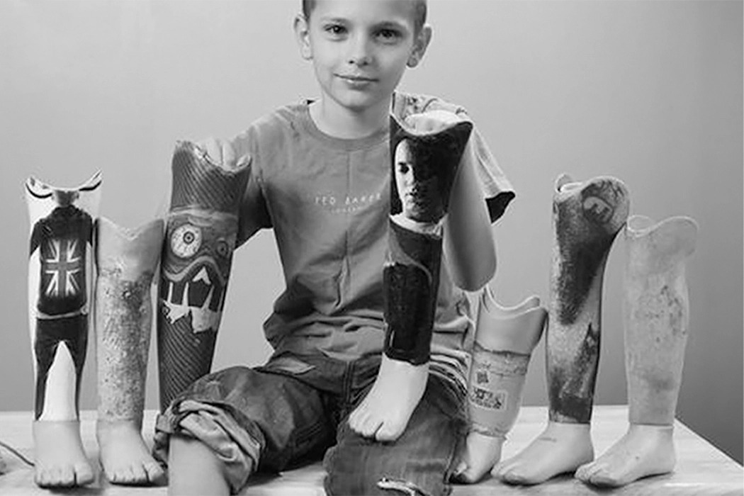 Prosthesis，ring，Adjustable，concept，Medical equipment，