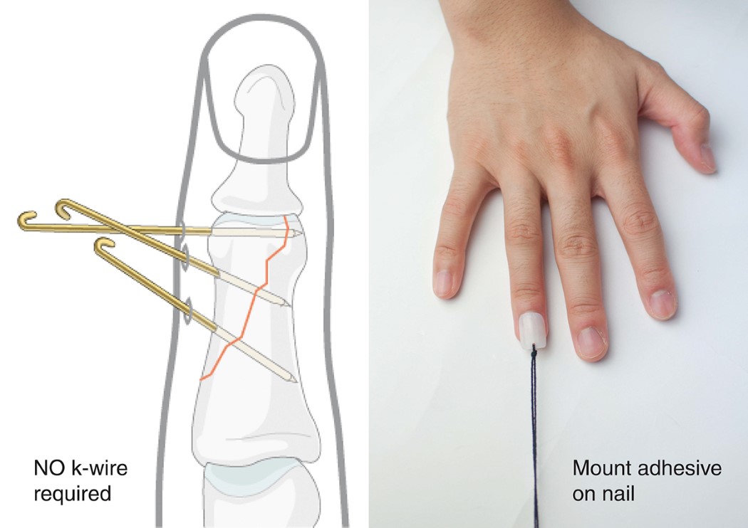 medical care，bend，fracture，finger，polymer，