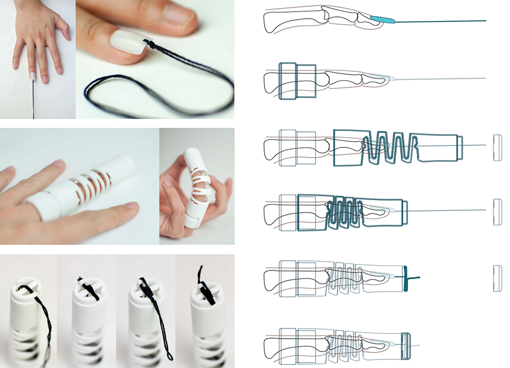 medical care，bend，fracture，finger，polymer，