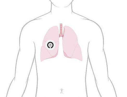 intelligence，Portable，Inhaler，asthma，