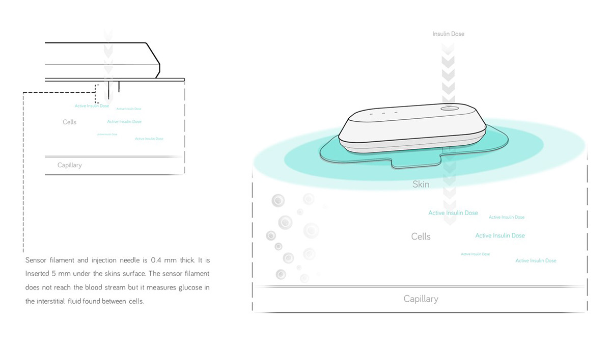 Insulite，Diabetes，insulin，