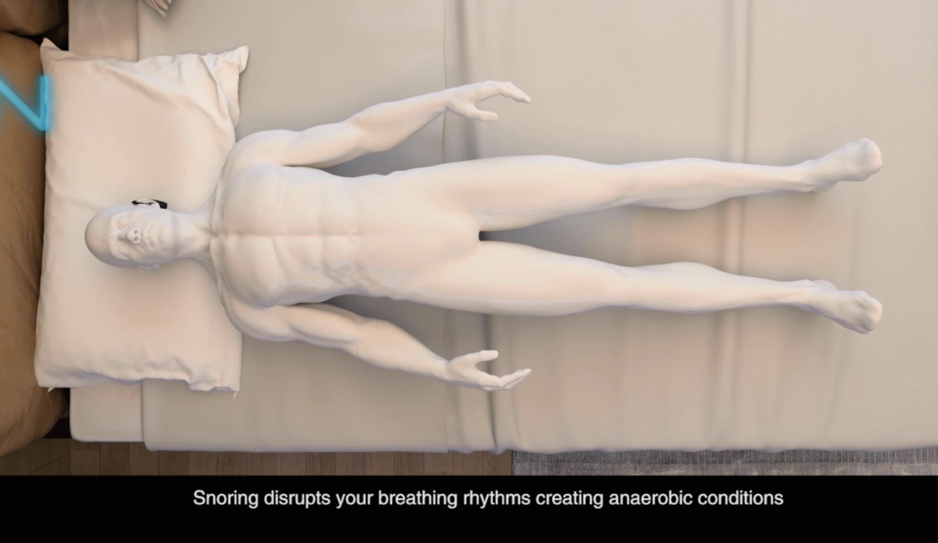 Anti Snoring artifact，