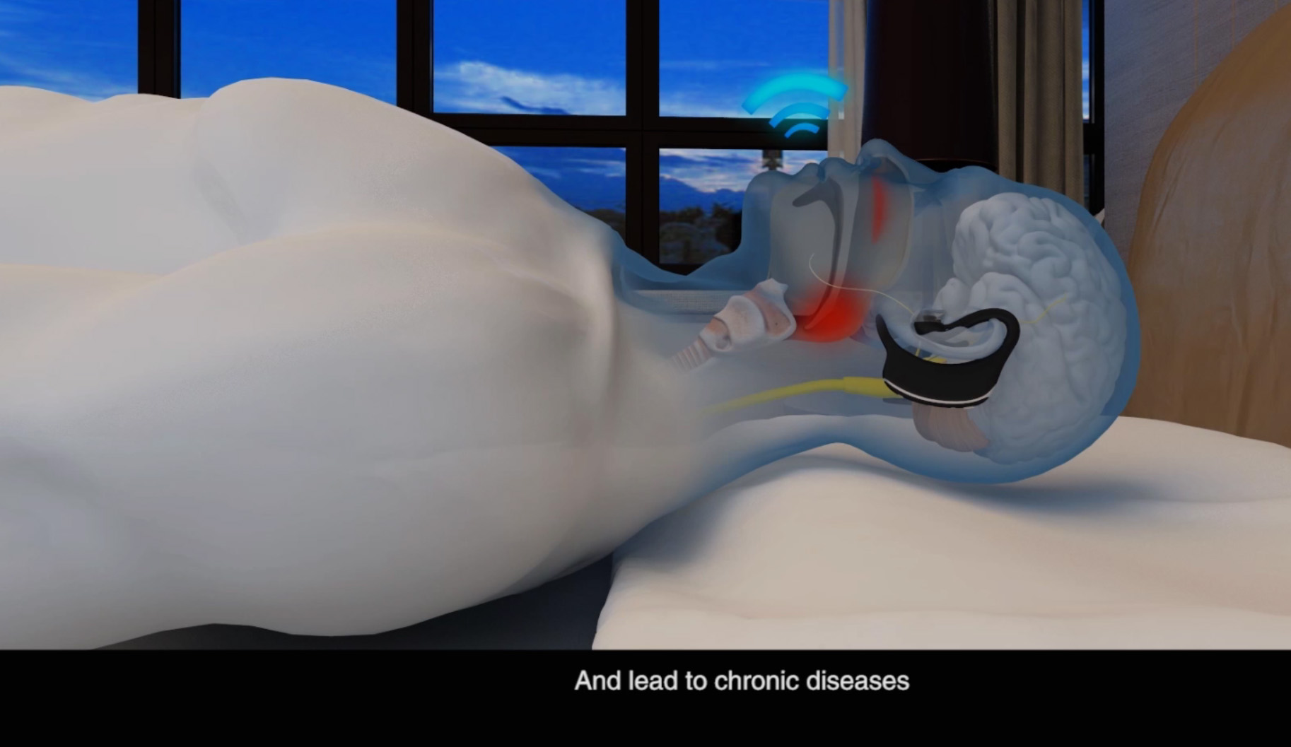 Anti Snoring artifact，