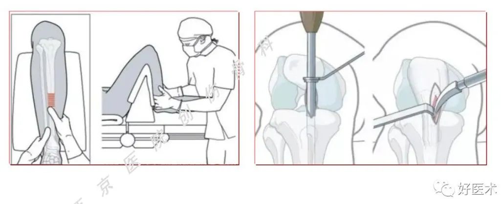 Intramedullary nail，