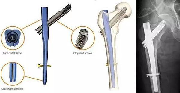 Intramedullary nail，