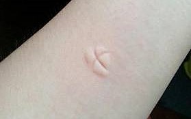 The pain is tolerable, but the itch is unbearable，
