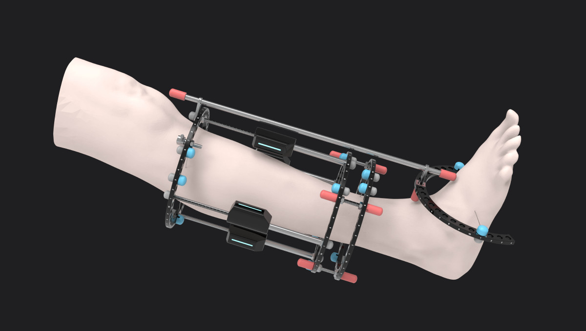 2021 undergraduate graduation design works，Graduation exhibition，School of Design, Hunan University ，Ilizanov，Bone scaffold，
