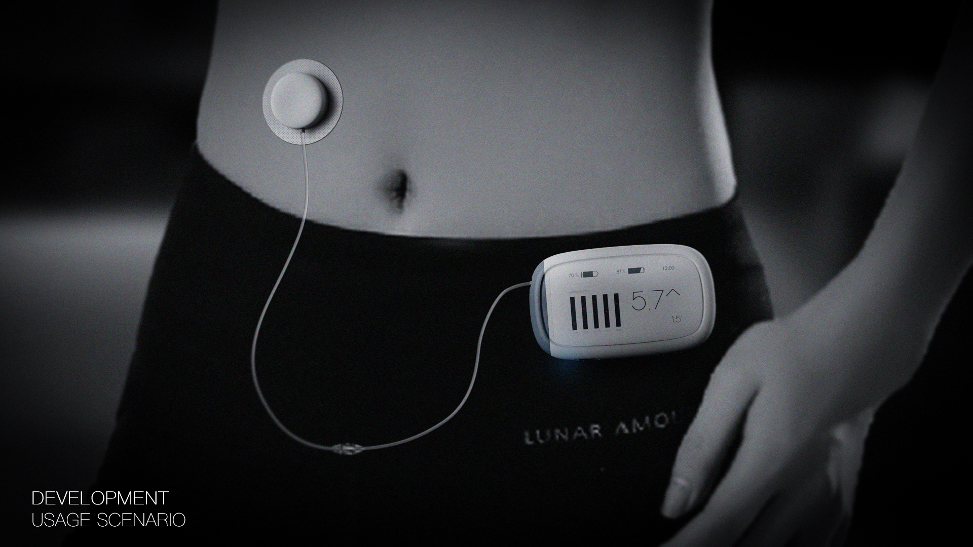 Medical products，Diabetes，insulin pump，hommization，