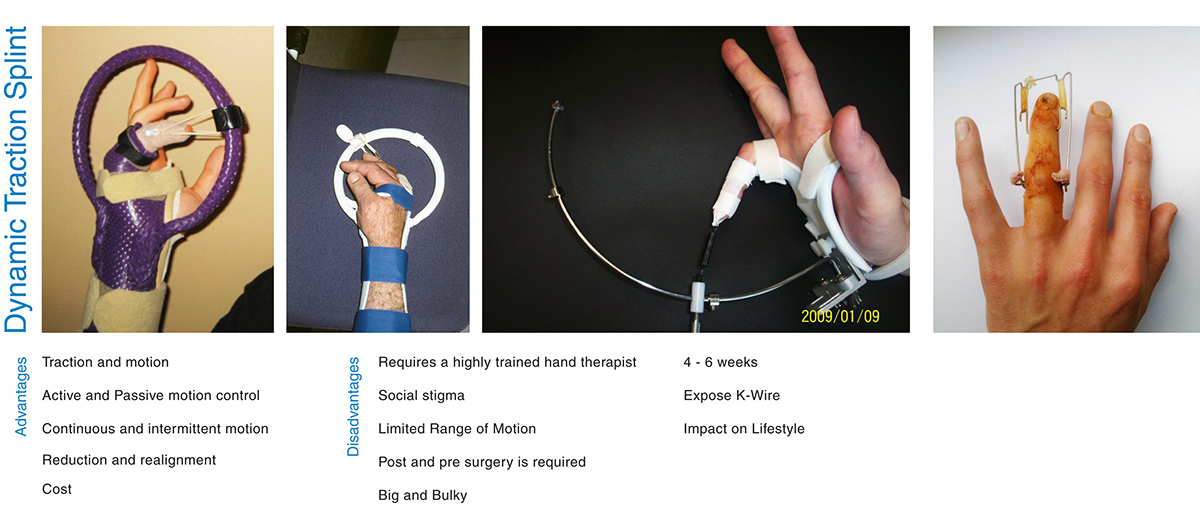 industrial design，Medical products，bend，Finger Division，