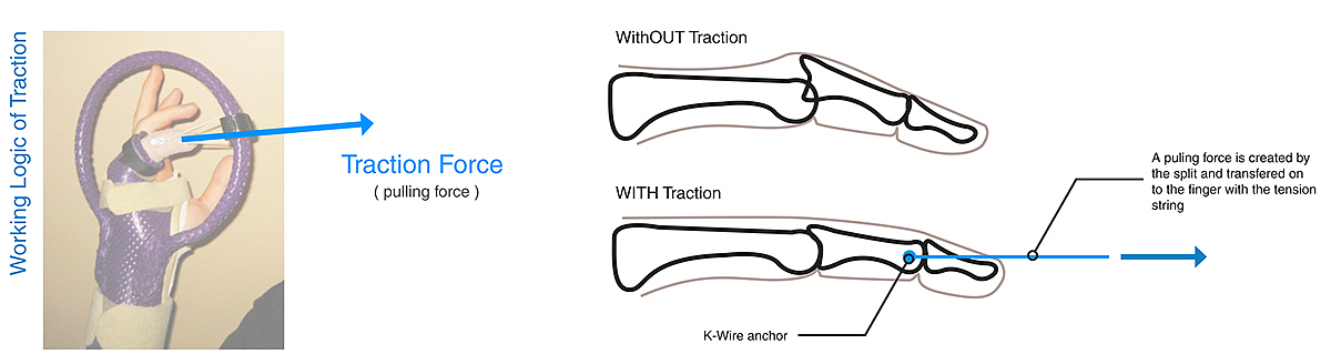 industrial design，Medical products，bend，Finger Division，