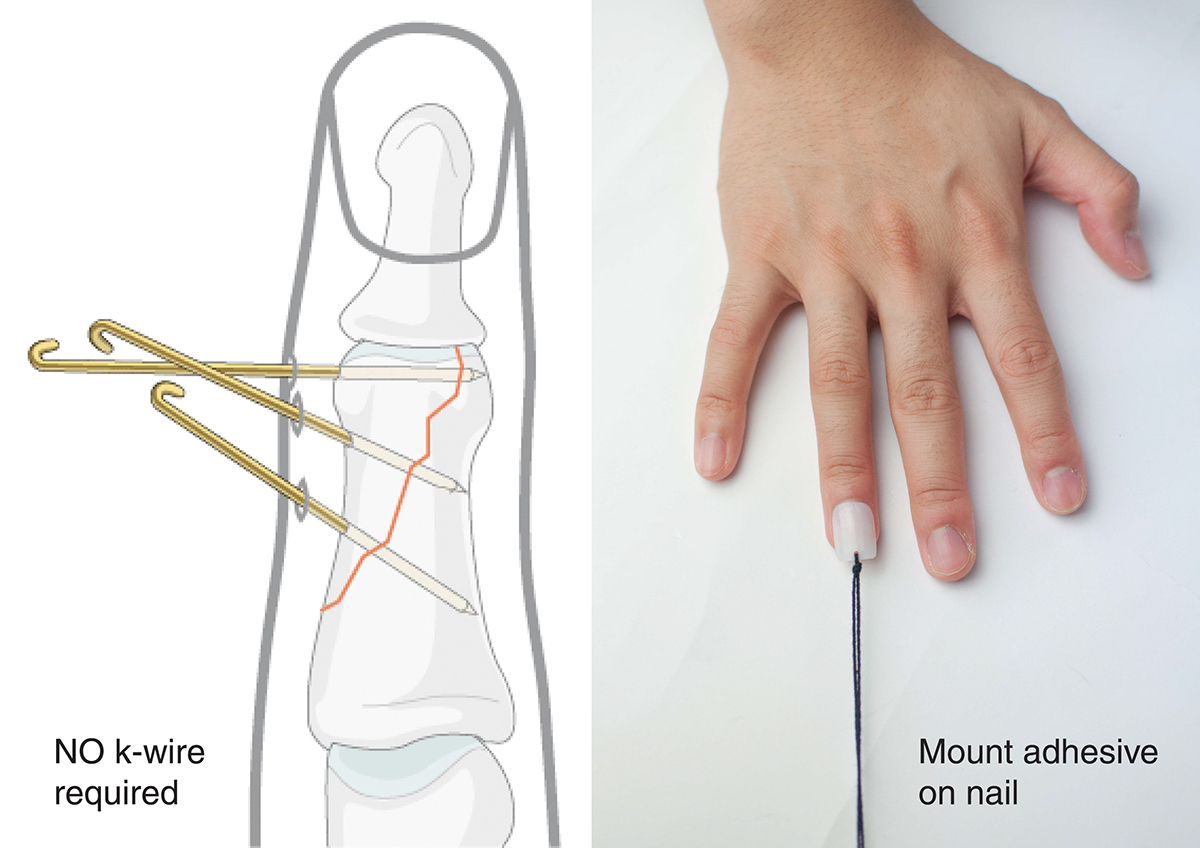 industrial design，Medical products，bend，Finger Division，