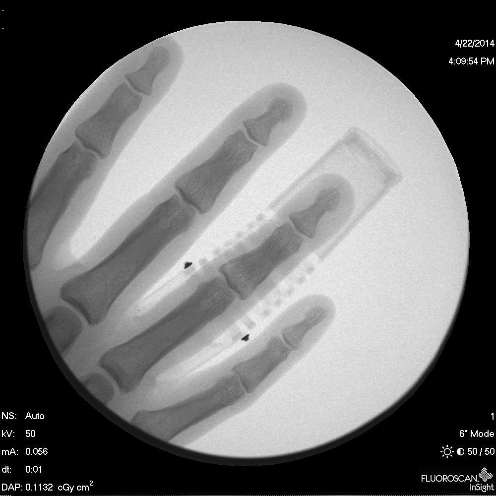 industrial design，Medical products，bend，Finger Division，