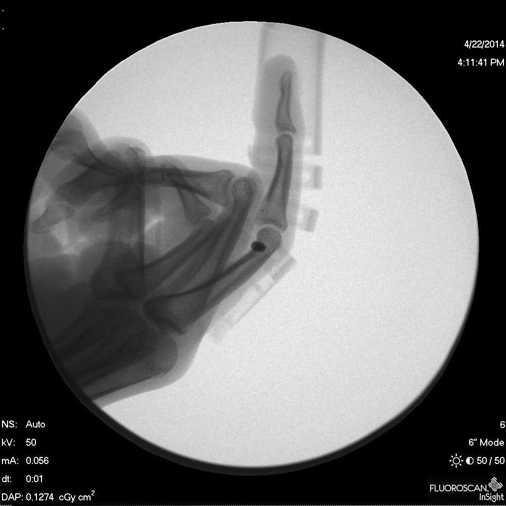 industrial design，Medical products，bend，Finger Division，