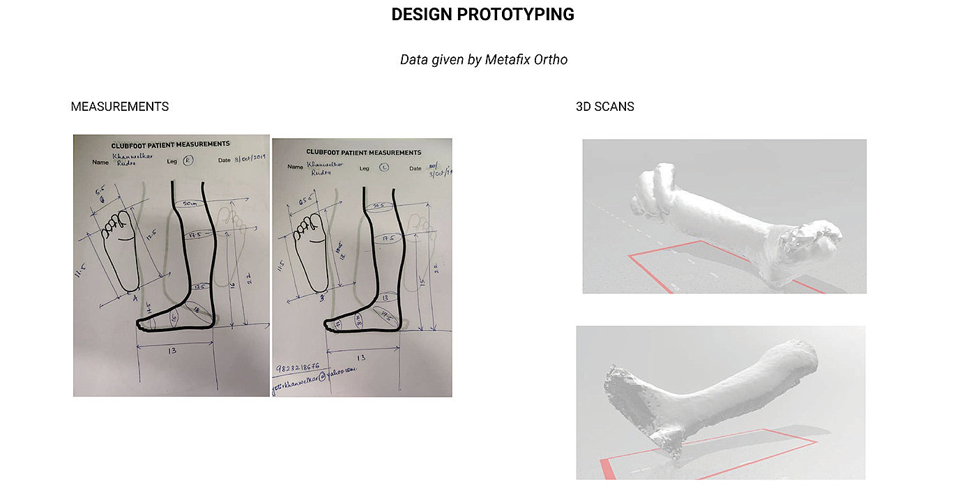 Clubfoot Splint Pattern Metafix Clubfoot Brace - 普象网