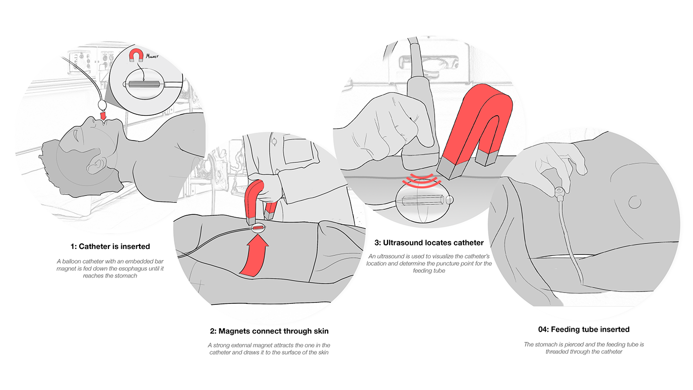 Coaptech，medical apparatus and instruments，medical care，Ergonomics，