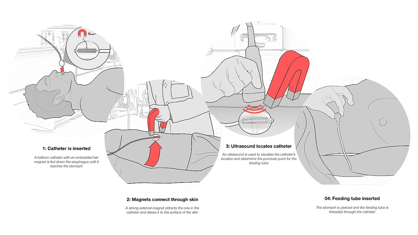 Coaptech，medical apparatus and instruments，medical care，Ergonomics，