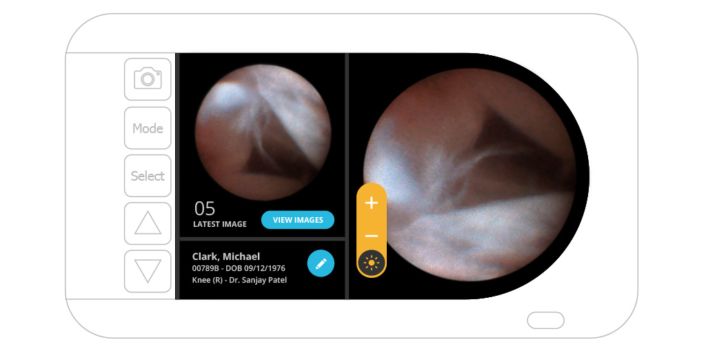 Trice Medical，Medical care equipment，Treatment of joint injury，