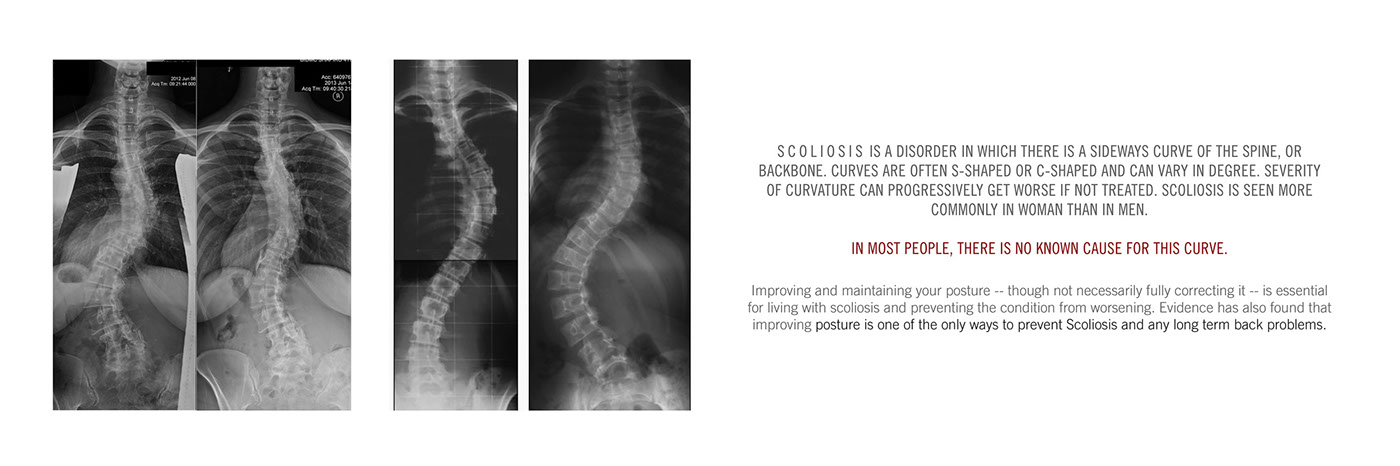 Reprint，medical care，Scoliosis posterior brace，correct，