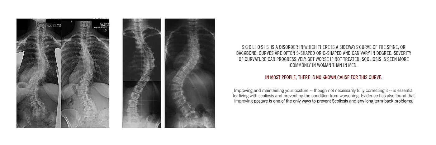 Reprint，medical care，Scoliosis posterior brace，correct，