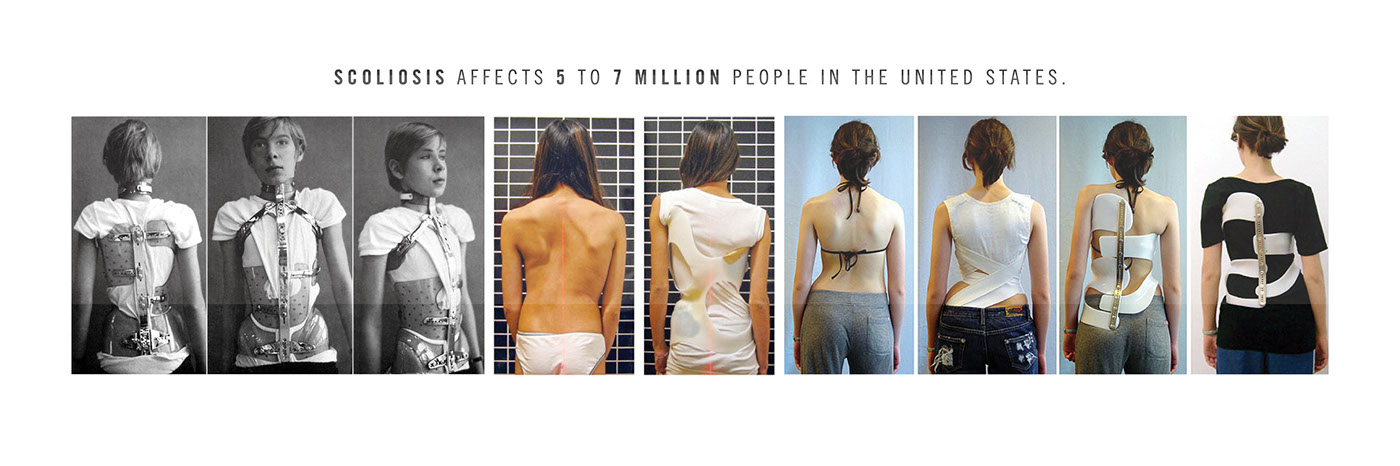 Reprint，medical care，Scoliosis posterior brace，correct，