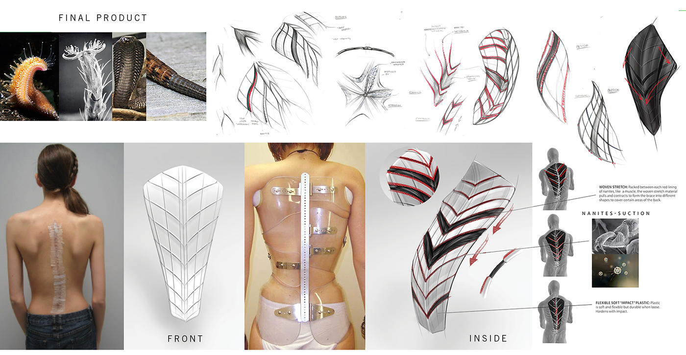 Reprint，medical care，Scoliosis posterior brace，correct，