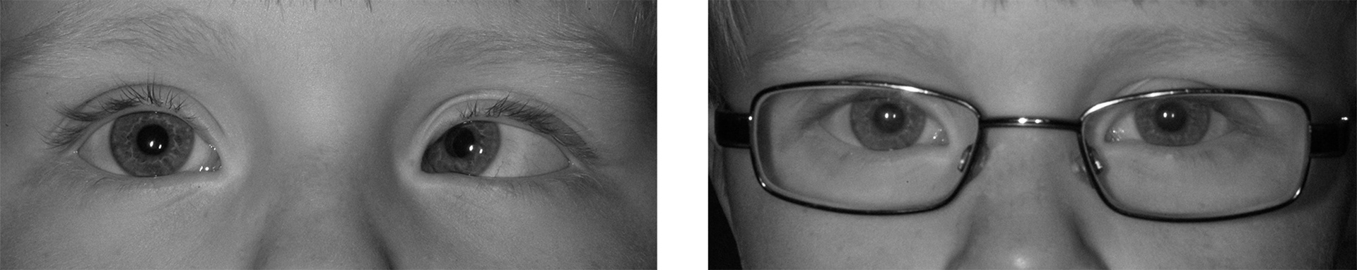 children，Wearable ，Strabismus treatment，