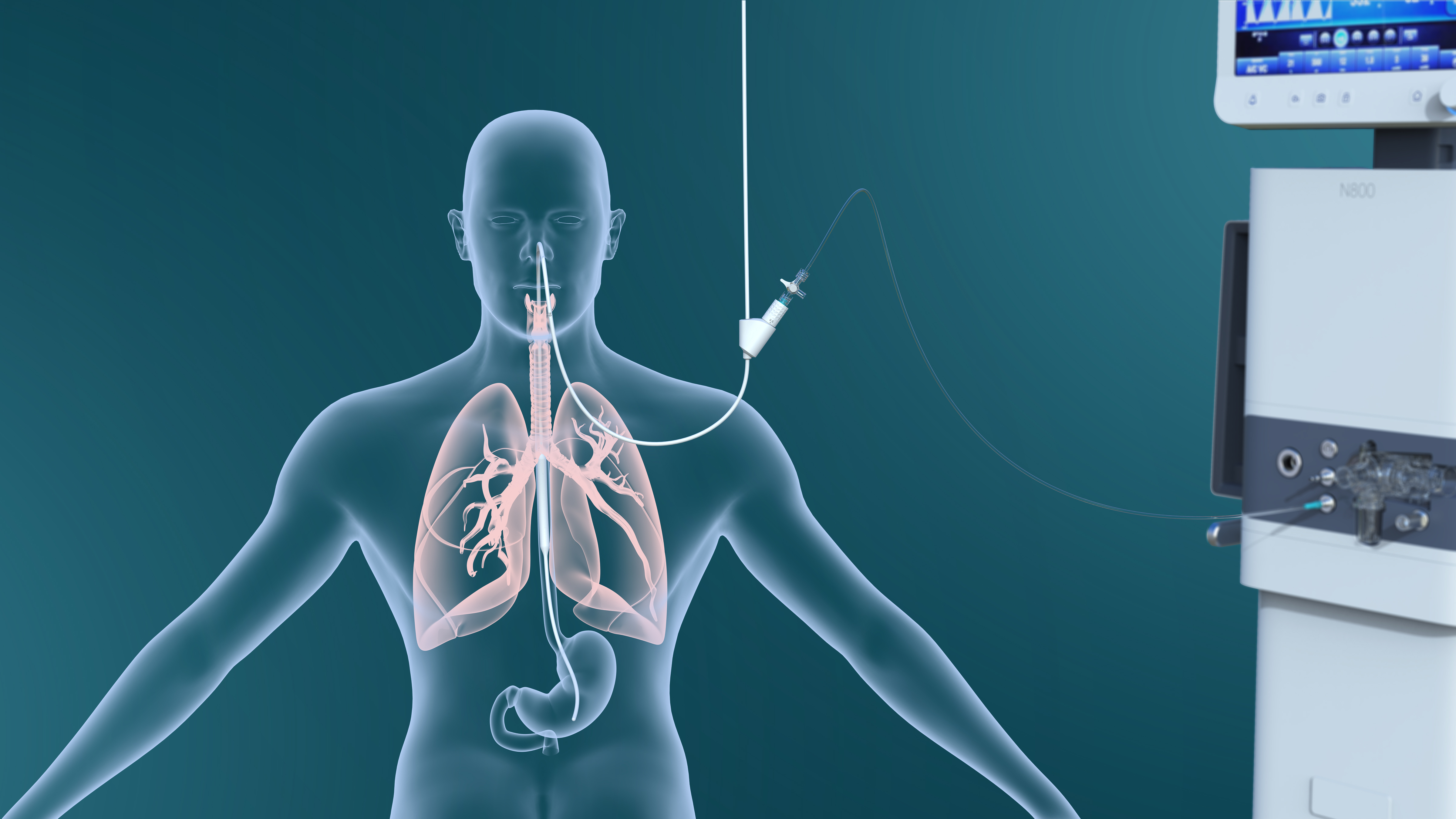 Esophageal pressure，gastric pressure，trans-pulmonary pressure，nasal feeding，Diaphragmatic electrical signal monitoring，Multi-function medical catheter，