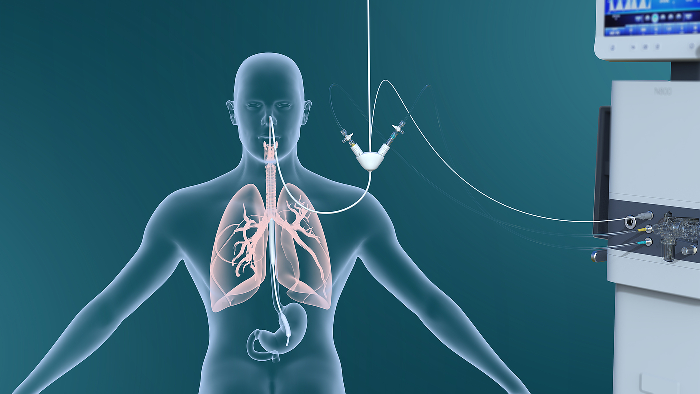 Esophageal pressure，gastric pressure，trans-pulmonary pressure，nasal feeding，Diaphragmatic electrical signal monitoring，Multi-function medical catheter，