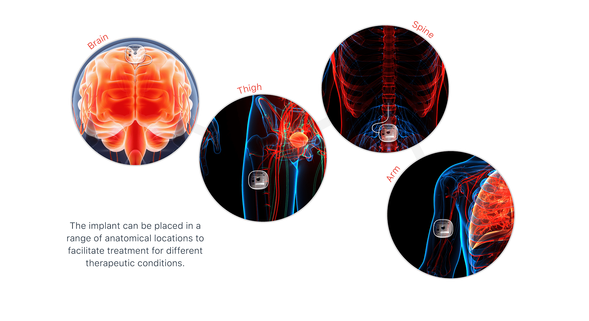 Parkinson，injection，Implantation，