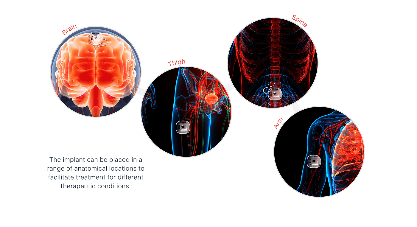 Parkinson，injection，Implantation，