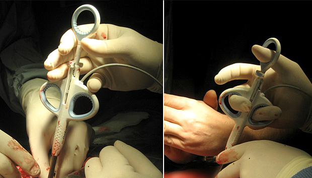 Scalpel，operation，Corr77，2013IDEA，heart surgery，