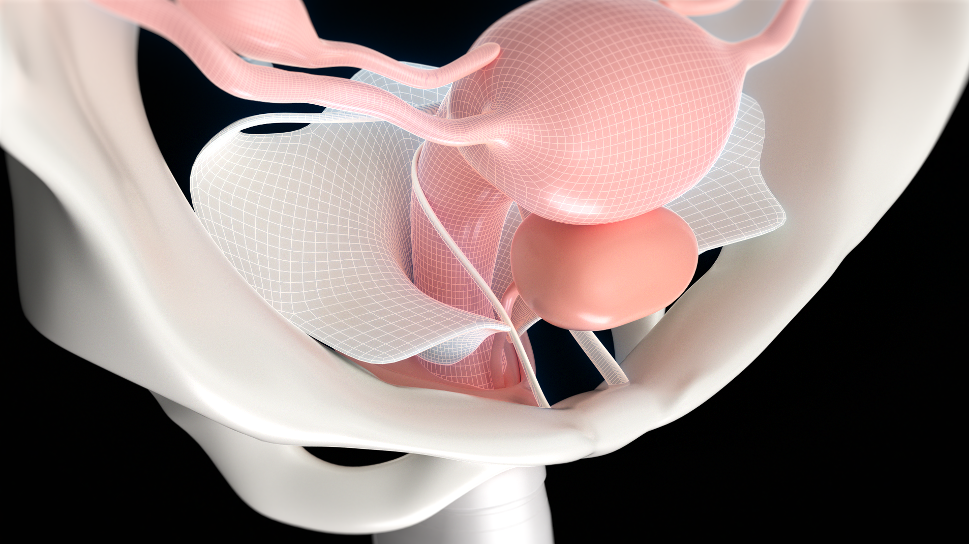 radio frequency，medical apparatus and instruments，Medical Animation，