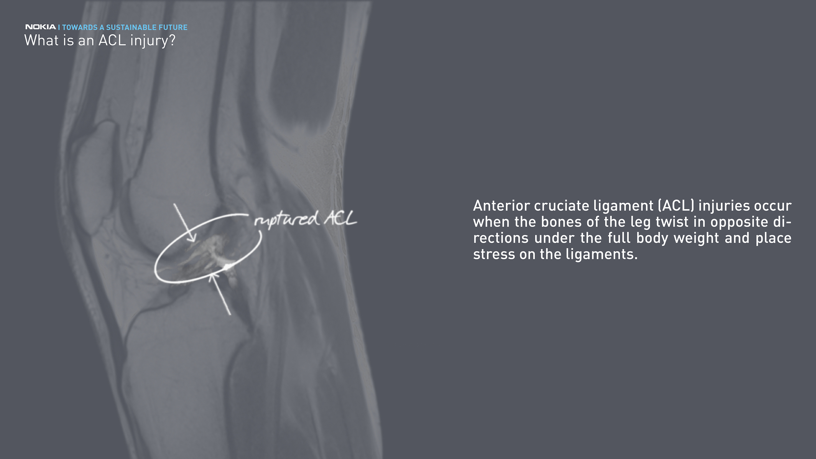 Reprint，Rik Oudenhoven，Exercise rehabilitation，monitor，