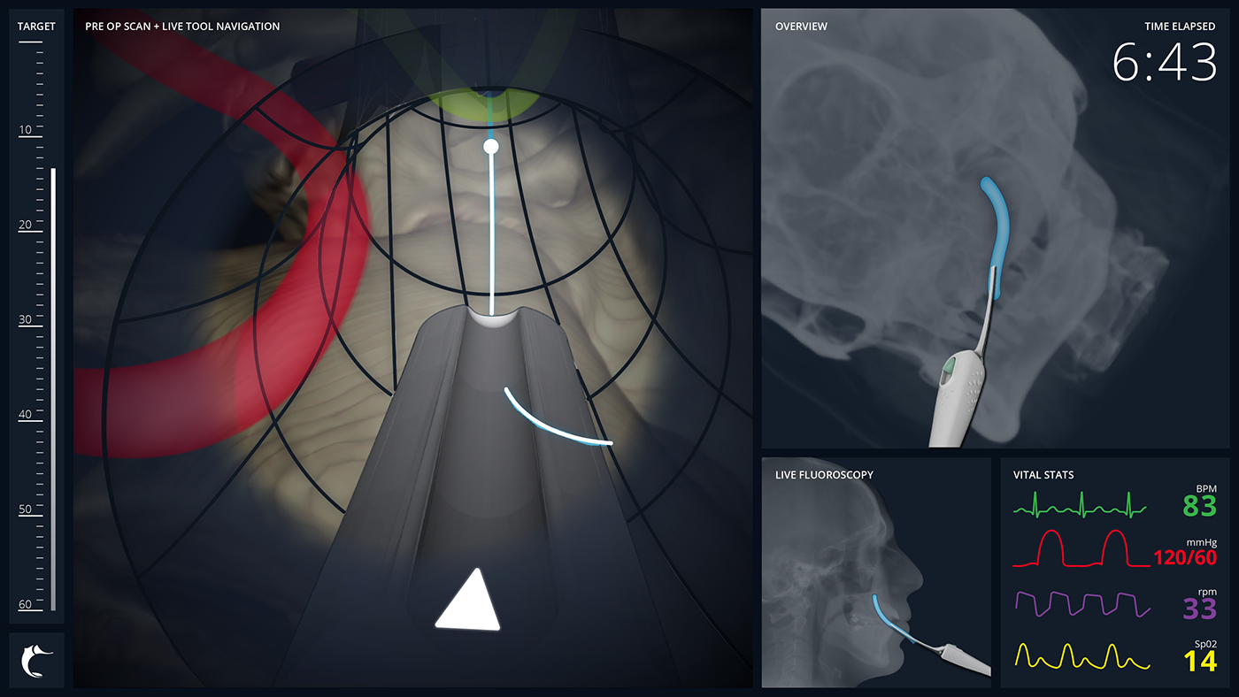 nerve，injection，Chimaera，